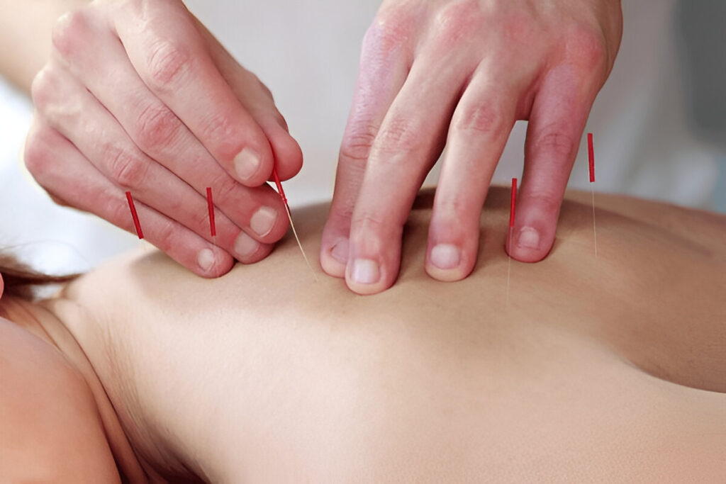 Benefits of Acupuncture for Your Overall Wellbeing